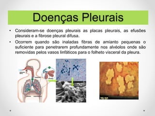 • Consideram-se doenças pleurais as placas pleurais, as efusões
pleurais e a fibrose pleural difusa.
• Ocorrem quando são inaladas fibras de amianto pequenas o
suficiente para penetrarem profundamente nos alvéolos onde são
removidas pelos vasos linfáticos para o folheto visceral da pleura.
Doenças Pleurais
 