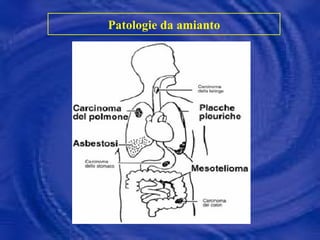 Patologie da amianto 