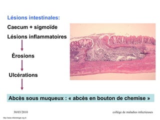 30/03/2010 collège de maladies infectieuses
Lésions intestinales:
Caecum + sigmoïde
Lésions inflammatoires
Érosions
Ulcérations
Abcès sous muqueux : « abcès en bouton de chemise »
http://www.infectiologie.org.tn
 