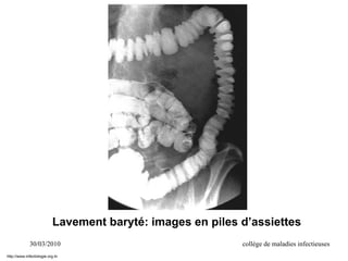 30/03/2010 collège de maladies infectieuses
Lavement baryté: images en piles d’assiettes
http://www.infectiologie.org.tn
 