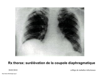 30/03/2010 collège de maladies infectieuses
Rx thorax: surélévation de la coupole diaphragmatique
http://www.infectiologie.org.tn
 