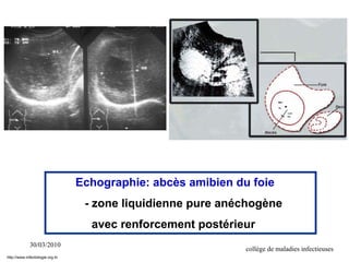 30/03/2010
collège de maladies infectieuses
Echographie: abcès amibien du foie
- zone liquidienne pure anéchogène
avec renforcement postérieur
http://www.infectiologie.org.tn
 