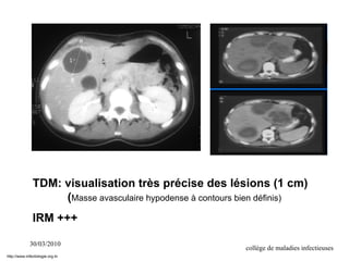 30/03/2010
collège de maladies infectieuses
TDM: visualisation très précise des lésions (1 cm)
(Masse avasculaire hypodense à contours bien définis)
IRM +++
http://www.infectiologie.org.tn
 