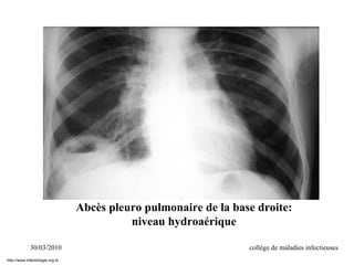 30/03/2010 collège de maladies infectieuses
Abcès pleuro pulmonaire de la base droite:
niveau hydroaérique
http://www.infectiologie.org.tn
 