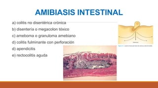 Amibiasis | PPTX