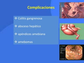 Complicaciones
 Colitis gangrenosa
 absceso hepático
 apéndices amebiana
 amebomas
 