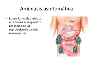 Amibiasis asintomática
• Es una forma de amibiasis
no invasiva se diagnostica
por medio de un
coprologico el cual solo
revela quistes.

 