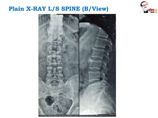 Plain X-RAY L/S SPINE (B/View)
 