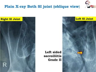 Plain X-ray Both SI joint (oblique view)
Left SI Joint
Right SI Joint
Left sided
sacroiliitis
Grade II
 