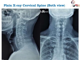 Plain X-ray Cervical Spine (Both view)
 
