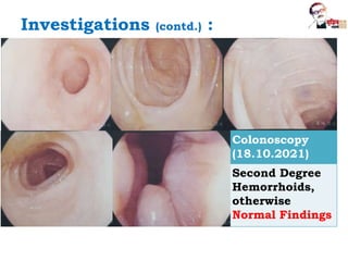 Investigations (contd.) :
Colonoscopy
(18.10.2021)
Second Degree
Hemorrhoids,
otherwise
Normal Findings
 