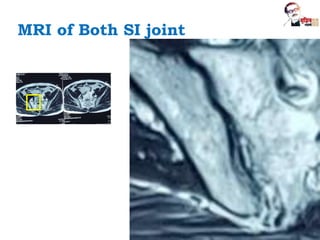 MRI of Both SI joint
 