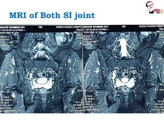 MRI of Both SI joint
 