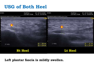 USG of Both Heel
Rt Heel Lt Heel
Left plantar fascia is mildly swollen.
 