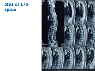 MRI of L/S
spine
 