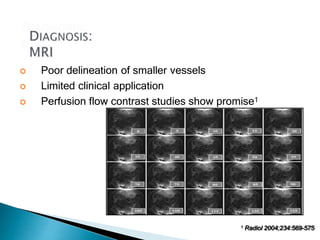  Poor delineation of smaller vessels
 Limited clinical application
 Perfusion flow contrast studies show promise1
1 Radiol 2004;234:569-575
 