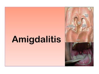 Amigdalitis
 