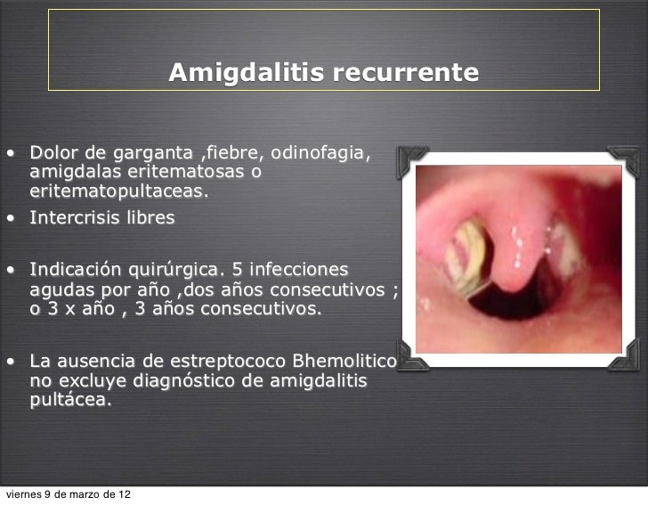 Amigdalas Y Adenoides