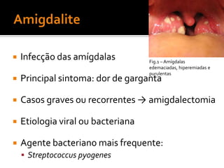 AmigdaliteInfecção das amígdalas