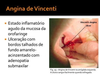 Haemophilus - estruturaParede celularTípica de bastonetes Gram - Lipopolissacarídio com actividade de endotoxinaMembrana externa – proteinas espécie e estirpe especificos.Fig. 19 – Estrutura de bactérias Gram-