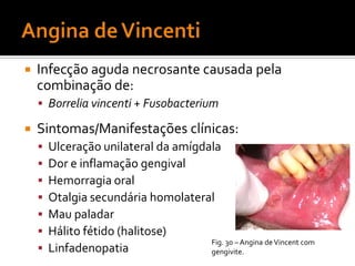 Haemophilus - espéciesTabela2  – Espécies de  haemophilus associadas a doença humanaVirulência:O H. influenzae tipo b é o mais virulento – PRP na cápsulaO Haemophilus adere às células hospedeiras via pilli e outras estruturas