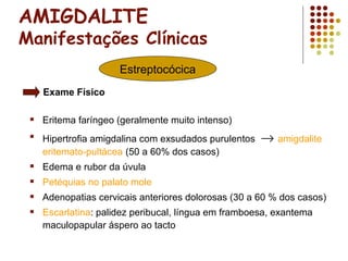 AMIGDALITE
Manifestações Clínicas
 Eritema faríngeo (geralmente muito intenso)
 Hipertrofia amigdalina com exsudados purulentos → amigdalite
eritemato-pultácea (50 a 60% dos casos)
 Edema e rubor da úvula
 Petéquias no palato mole
 Adenopatias cervicais anteriores dolorosas (30 a 60 % dos casos)
 Escarlatina: palidez peribucal, língua em framboesa, exantema
maculopapular áspero ao tacto
Estreptocócica
Exame Físico
 