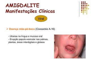 AMIGDALITE
Manifestações Clínicas
Viral
- Úlceras na língua e mucosa oral
- Erupção papulo-vesicular nas palmas,
plantas, áreas interdigitais e glúteos
 Doença mão-pé-boca (Coxsackie A-16)
 