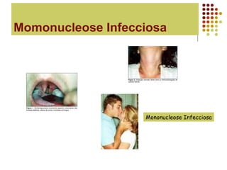 Momonucleose Infecciosa
Mononucleose Infecciosa
 