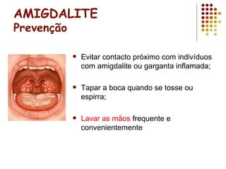AMIGDALITE
Prevenção
 Evitar contacto próximo com indivíduos
com amigdalite ou garganta inflamada;
 Tapar a boca quando se tosse ou
espirra;
 Lavar as mãos frequente e
convenientemente
 