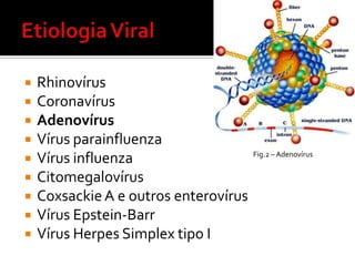 Enfermidades das amígdalas e adenóidesAmigdaliteagudaAmigdalitecrônica (recorrente)Hiperplasiaobstrutiva de  amígdalas e adenóidesHiperplasia de adenóidesDiversos