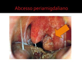 Haemophilusinfluenzae