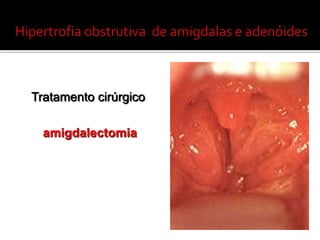 Amigdalites - ComplicaçõesPortanto, para que ocorra a Febre ReumáticaUma infecção de garganta causada pelo estreptococo.Onão tratamento da infecção com o antibiótico adequado e o tempo correto de uso. Uma predisposição genética individual.