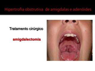Amigdalitecrônica (recorrente)Amigdalite aguda recorrente: 7 episódios em 1 ano; 5 episódios por ano em 2 anos consecutivos ou 3 episódios por ano em 3 anos consecutivos. (NISA pediatricsapril 2011- MylaBoun)