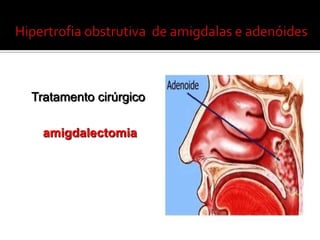 Amigdalitecrônica- MicrobiologiaStreptococcus pyogenes (Grupo A beta-hemolitico)H.influenzaS. aureusStreptococcus pneumoniae