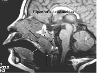 Fatores de risco para amigdalite aguda de repetição em criançasObjetivo: Avaliar os fatores de risco envolvidos na gênese de quadros de amigdalite aguda de repetição.Amostra analisada (5.600  crianças).Resultados:  Piores condições de hábitação, com moradias pequenas, com maior número de pessoas e presença de animais na mesma, a exposição passiva ao fumo e a redução do apetite foram estatisticamente mais freqüentes entre os com amigdalite aguda de repetição. Risk factors for recurrent acute tonsillitis in children – Jornal de alergia e imunologia  22ªed. Pag 22 e 23- 2007.