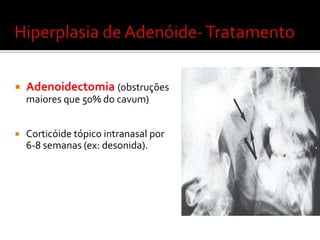Hipertrofiaobstrutiva  de amígdalas e adenóidesPrincipal causa de mortesúbitaemcrianças.Diagnóstico:Anamnese: Roncos + Apnéianoturna+hipersonolênciadiurna + irritabilidadeOroscopiaRadiografia de cavum