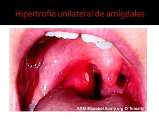 Hipertrofiaobstrutiva  de amigdalas e adenóidesTratamentocirúrgicoamigdalectomia