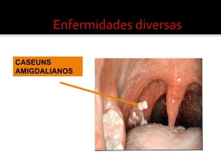 Hipertrofiaobstrutiva  de amigdalas e adenóidesTratamentocirúrgicoamigdalectomia