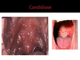 Hipertrofiaobstrutiva  de amigdalas e adenóidesTratamentocirúrgicoamigdalectomia