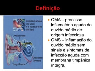 Hiperplasia de AdenóideTríadesintomática:VozhiponasalRoncosRespiração oralRinorréiapurulenta, gotejamentopós-nasal, tosse e cefaléiaFasciesadenoidiano