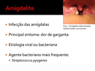 AmigdaliteInfecção das amígdalas