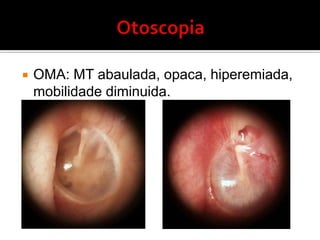 DefiniçãoOMA – processo inflamatório agudo do ouvido médio de origem infecciosaOMS – inflamação do ouvido médio sem sinais e sintomas de infecção aguda com membrana timpânica íntegra.