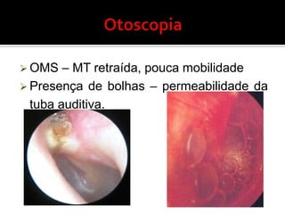 EpidemiologiaMais frequente em crianças de 6 meses a 6 anos.Mais prevalente no sexo masculino.Há aumento da incidência no inverno e primavera(IVAS).