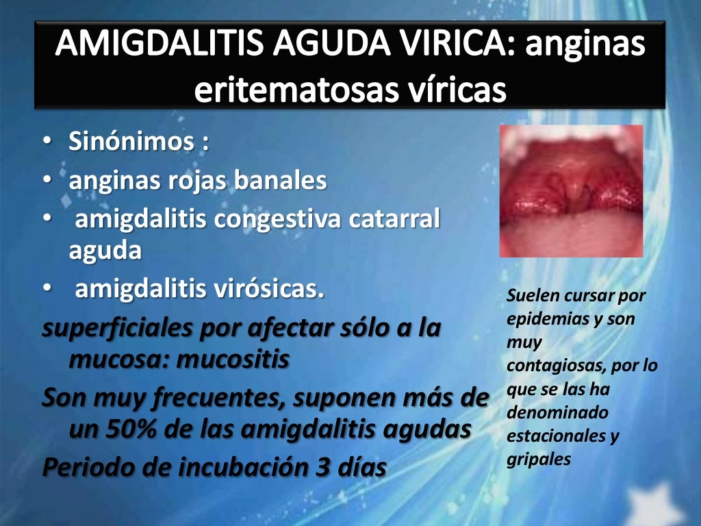Amigdalitis