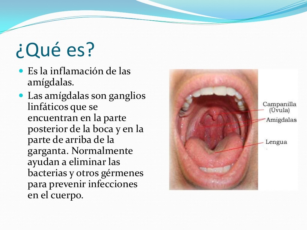 Amigdalitis