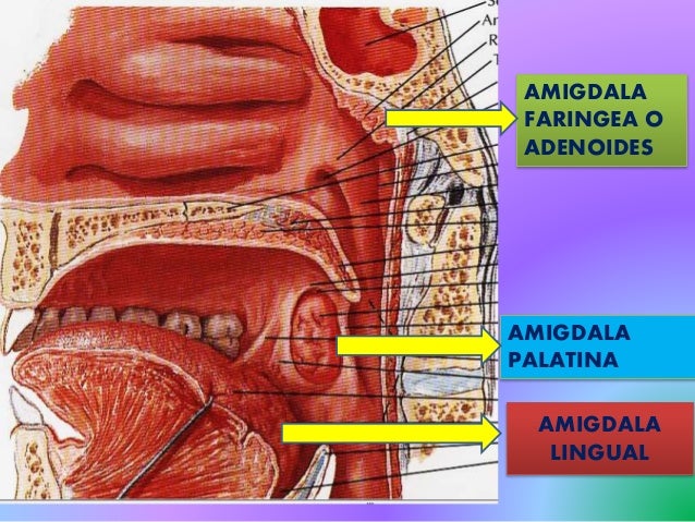 Amigdalitis. Joheman Urbina