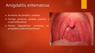 Amigdalitis eritematosa:
 Aumento de tamaño y eritema
 Faringe posterior, paladar superior y
úvula eritematosa
 Puntos blaquesinos cremosos en
amígdalas (eritematopultácea)
 