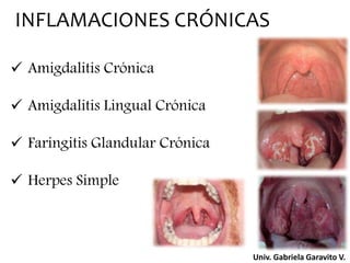 INFLAMACIONES CRÓNICAS
 Amigdalitis Crónica
 Amigdalitis Lingual Crónica
 Faringitis Glandular Crónica
 Herpes Simple
Univ. Gabriela Garavito V.
 