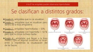 Grado 0 : amígdalas que no se visualizan
Grado 1 : amígdalas que se visualizan pero
dentro de la fosa amigdalina
Grado 2 : amígdalas hipertrofiadas < 50%
Grado 3 : amígdalas con hipertrofia > 50 %
pero que no tocan la línea media
Grado 4 : amígdalas que llegan a la línea
media y que en algunas ocasiones se tocan
entre sí impidiendo la visualización del
de las fauces.
A la EF las amígdalas pueden observarse hipertrofiadas
Se clasifican a distintos grados:
 