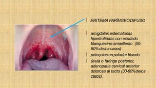  ERITEMA FARÍNGEODIFUSO
 amígdalas eritematosas
hipertrofiadas con exudado
blanquecino-amarillento (50-
90%delos casos)
 petequias enpaladar blando
 úvula o faringe posterior,
adenopatía cervical anterior
dolorosa al tacto (30-60%delos
casos).
 